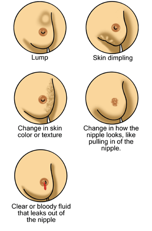 illustrations of breast cancer symptoms